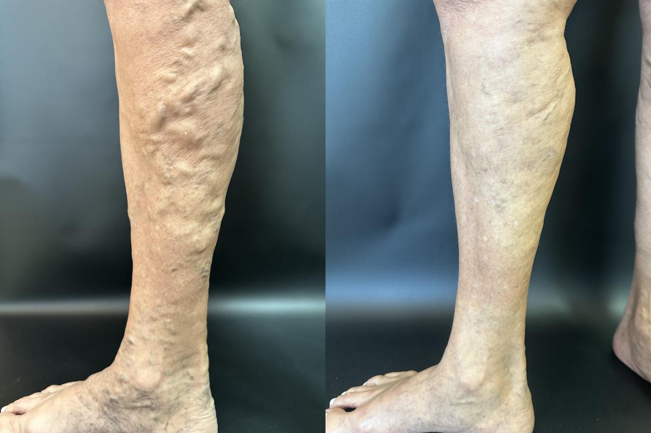 Resultado tratamento de varizes 1