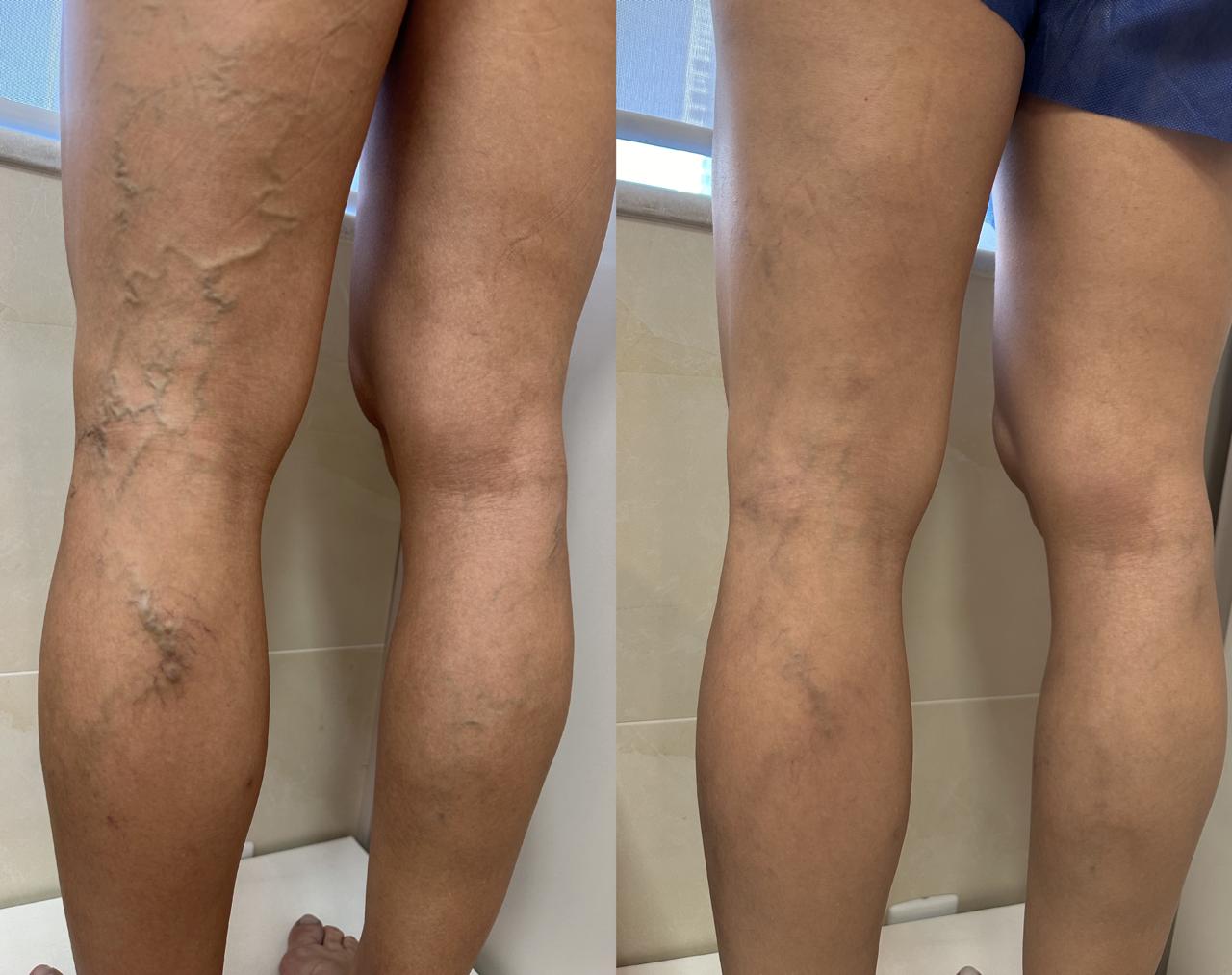 Resultado tratamento de varizes 2