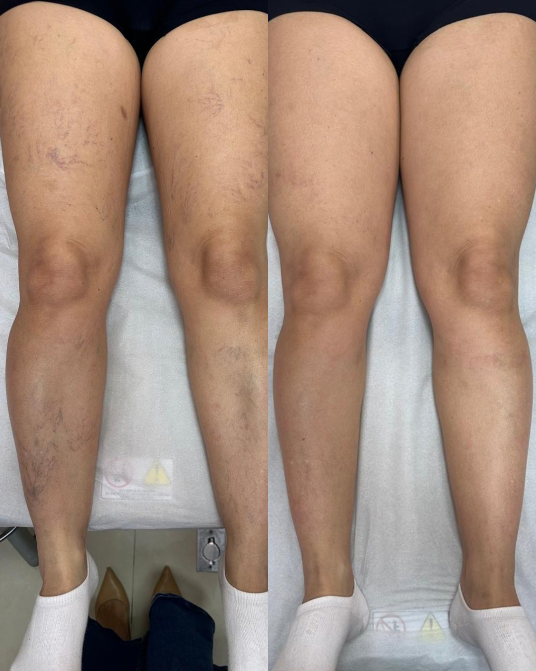 Resultado tratamento de varizes 5